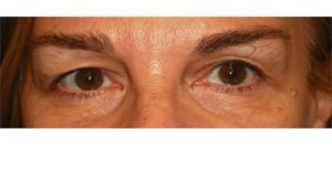 Manhattan BLEPHAROPLASTY Before 1